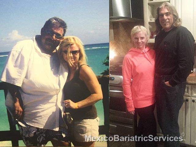 David Before & After Bariatric Surgery - Mexico