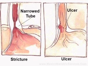 Stricture and Abscess After Bariatric Surgery