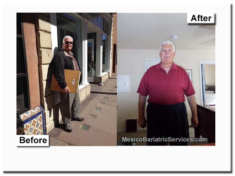 Review Of Gastric Sleeve In Mexico