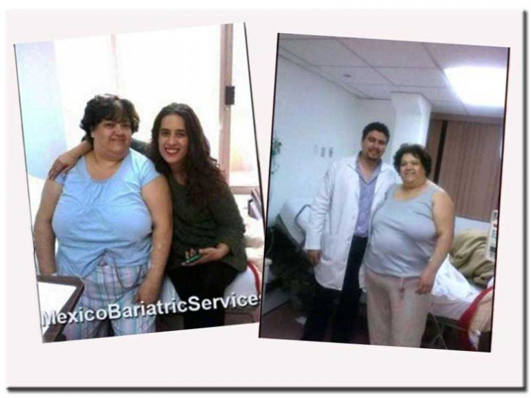 Stomach Sleeve in Tijuana – Ana’s Testimonial