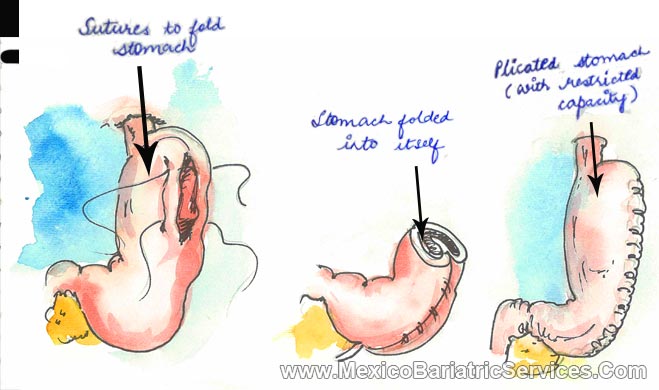 Gastric Plication in Tijuana - Mexico