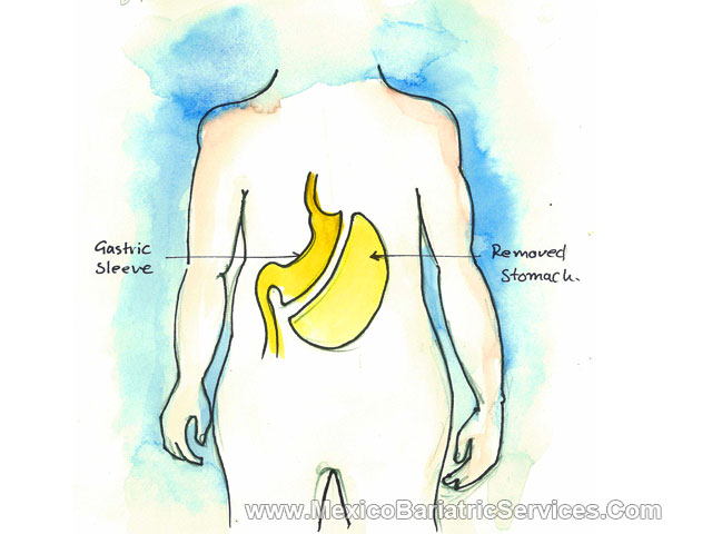 Gastric Sleeve in Mexicali - Mexico