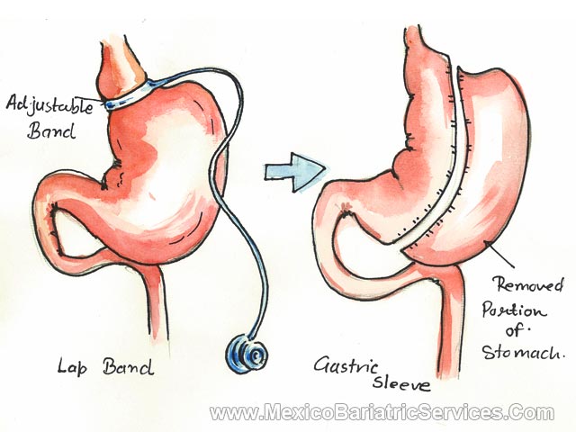 Revision Weight Loss Surgery in Mexico