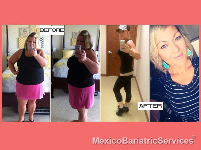 Deborah Before - After Bariatric Surgery - Tijuana