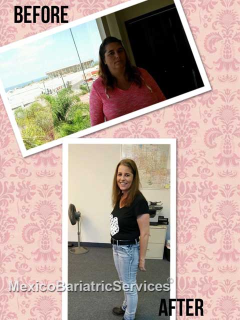 Shelly Before-After Weight Loss Surgery - Mexico