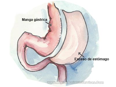 Manga Gastrica-Tijuana