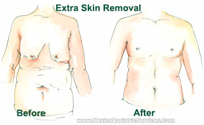 Plastic Surgery After Weight Loss - Mexico