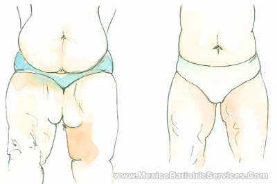 Thighplasty in Mexico - Before-and-After