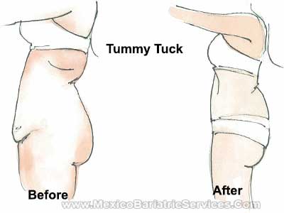 Tummy Tuck in Mexico - Before-and-After