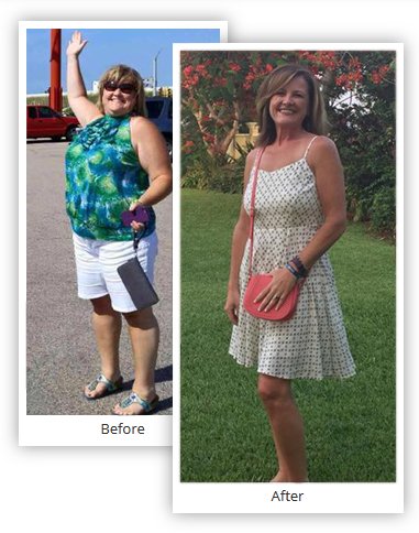 Gastric Sleeve Surgery Results Pictures - Mexico