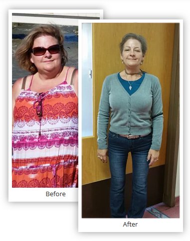 Bariatric Surgery Results Pictures Before and After - Mexico