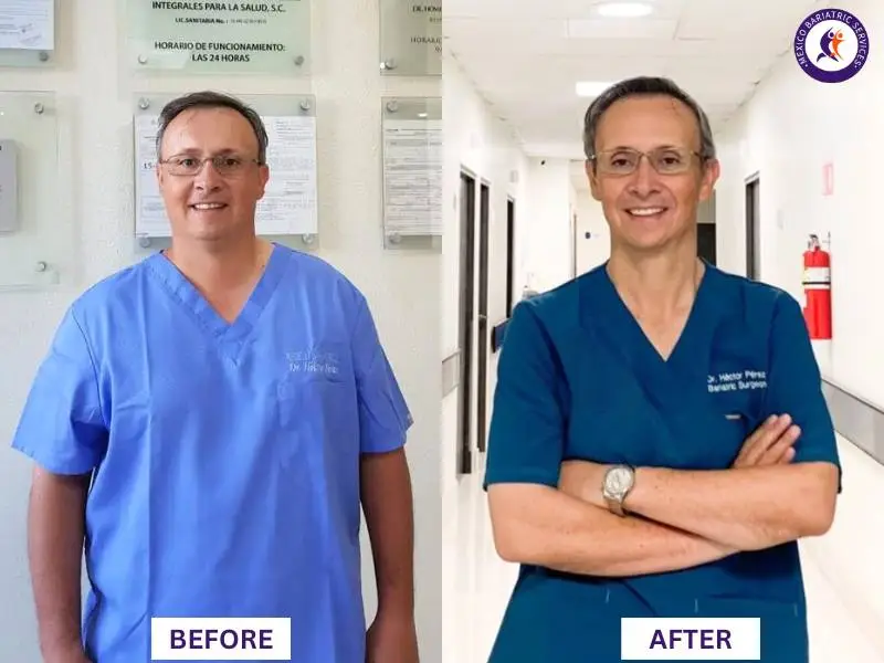 Dr. Hector Perez Corzo  Before and After Bariatric Surgery