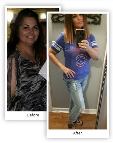 Vertical Gastric Sleeve Before and After - Mexico