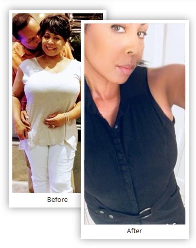 Pictures of People who had Gastric Sleeve Before and After - Mexico