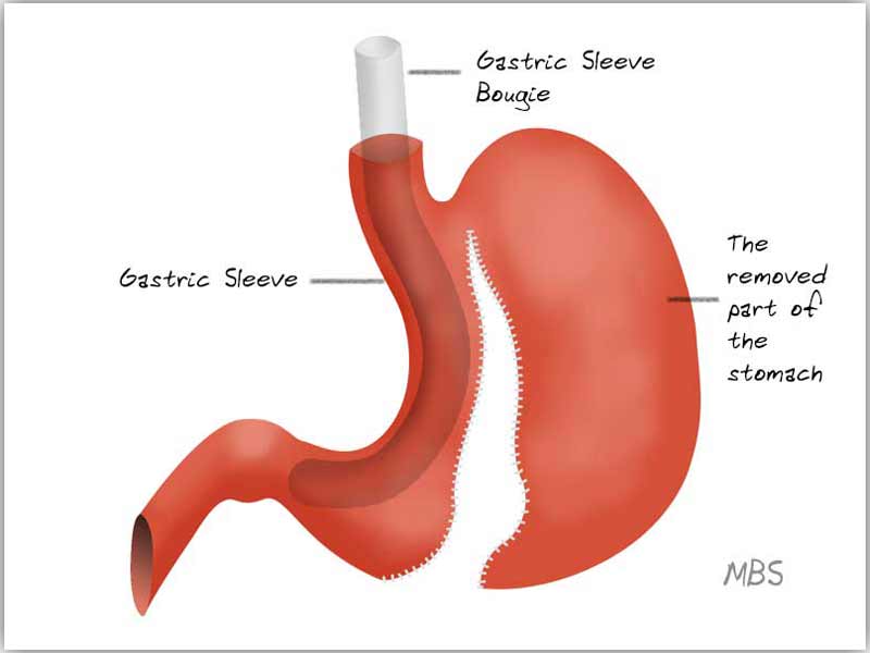 Gastric sleeve Bougie