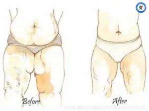 Tummy Tuck Before and After