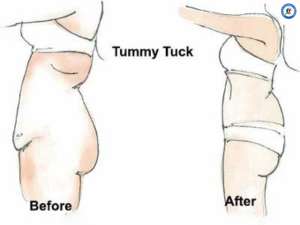 Tummy Tuck Before and After