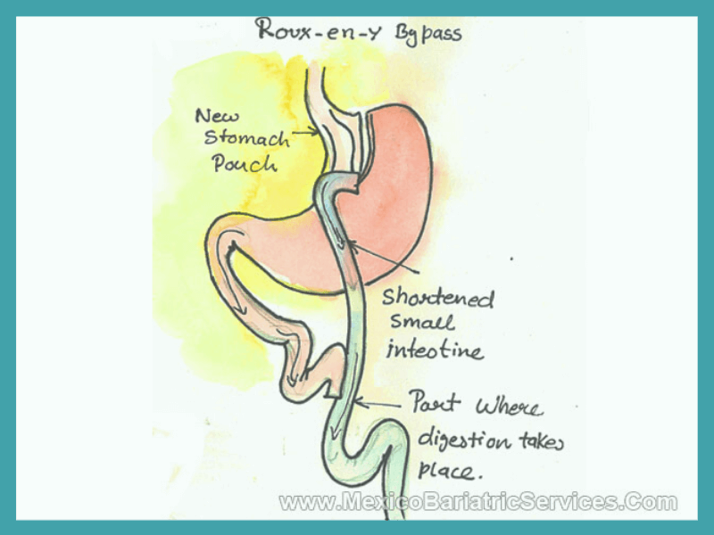 gastric Bypass in Mexico