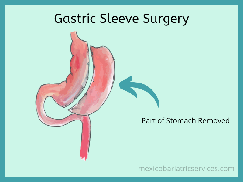 Gastric Sleeve in Mexico 