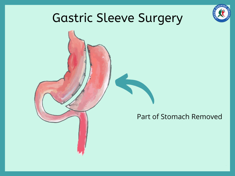 Gastric-sleeve-surgery in Reynosa Gastric-sleeve-surgery in Reynosa