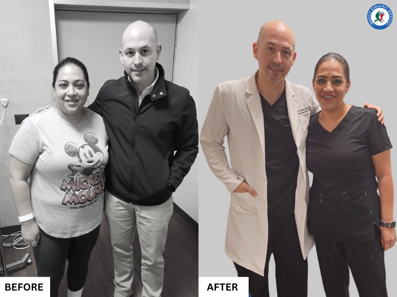 Bariatric Surgery in Piedras Negras, Mexico | Before & After Bariatric Surgery in Piedras Negras, Mexico | Before & After