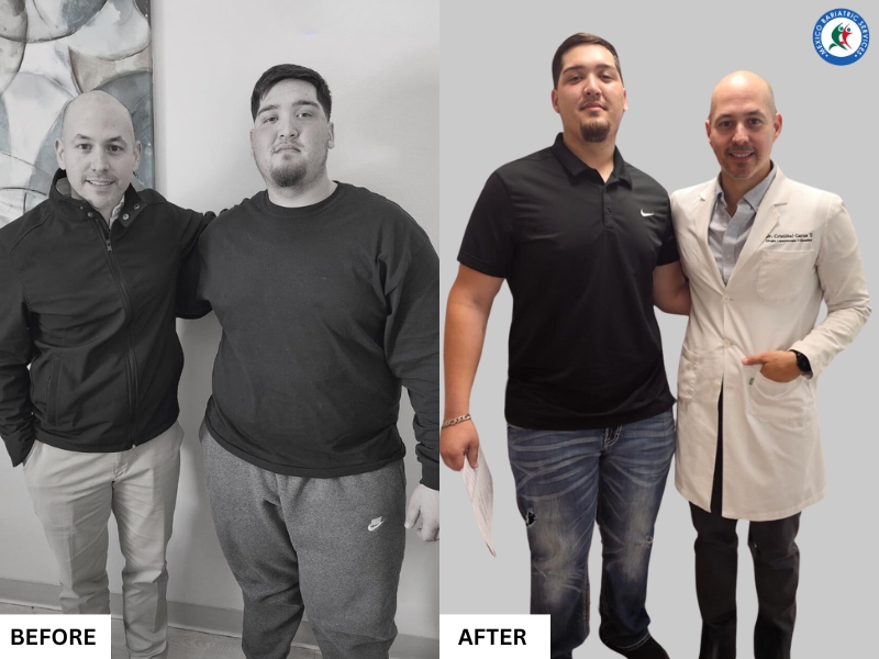 Bariatric Surgery in Piedras Negras, Mexico | Before & After Bariatric Surgery in Piedras Negras, Mexico | Before & After