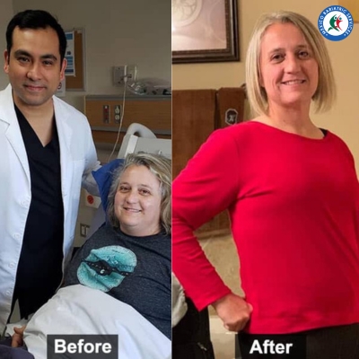 Gastric Bypass in Mexico