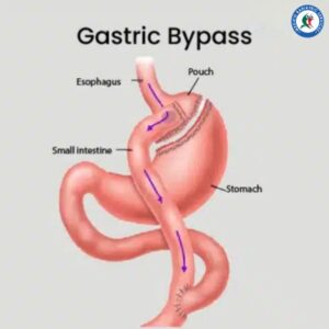 Gastric Bypass in Piedras Negras, Mexico Gastric Bypass in Piedras Negras, Mexico
