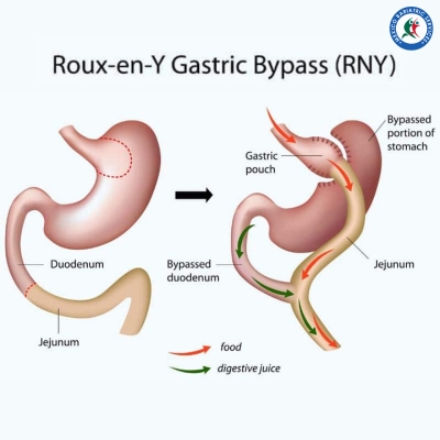 Gastric Bypass Surgery