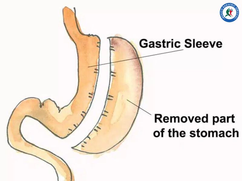 Gastric Sleeve