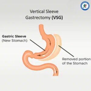 Gastric Sleeve in Piedras Negras, Mexico