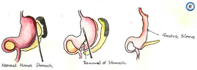 Gastric sleeve in Mexico