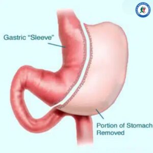 Mini Laparoscopic Sleeve in Piedras Negras Mini Laparoscopic Sleeve in Piedras Negras