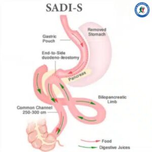 SADI-S in Piedras Negras