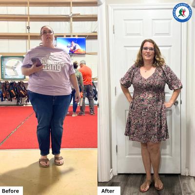 Stephanie Meyers Donn from Florida, US lost 325 lbs with Gastric Sleeve in Cancun