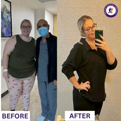 Before & After Gastric Bypass in Puerto Vallarta