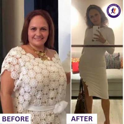 Before & After Gastric Bypass in Puerto Vallarta