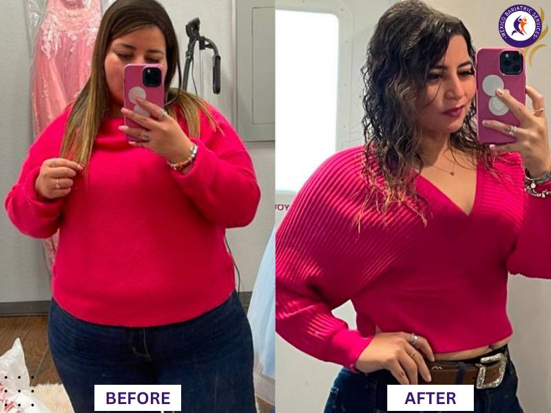 Dr. Galileo Villarreal Before after, lost 118LB with gastric sleeve surgey