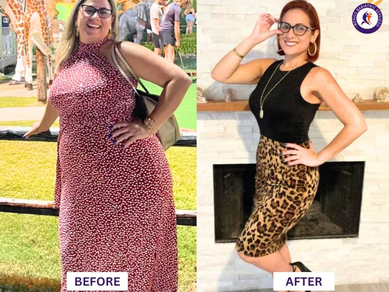 Dr. Galileo Villarreal Before after, Alejandra Zacar&iacute;as lost 100LB with gastric sleeve surgery