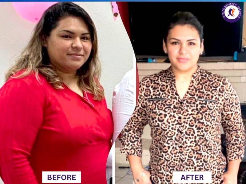 Dr. Galileo Villarreal Before after, Karina