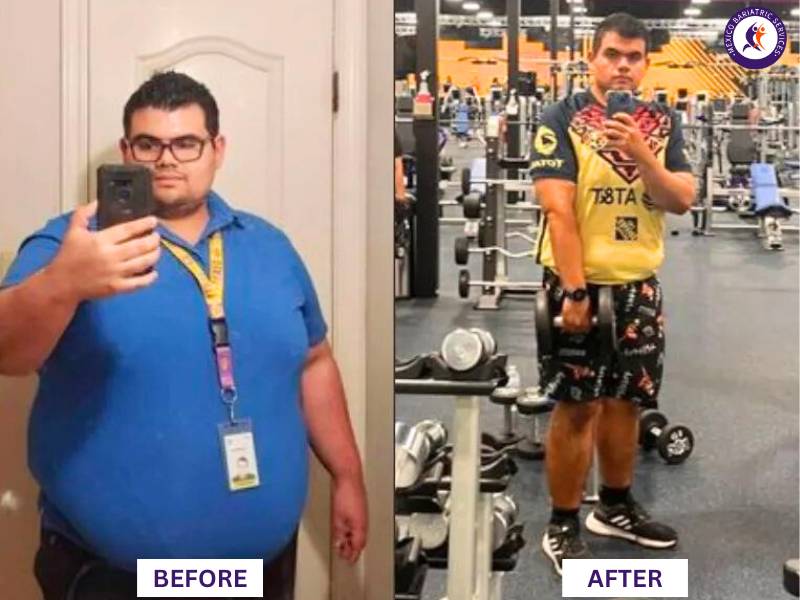 Dr. Galileo Villarreal Before after, Lauro