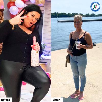 Fanie Roy from Canada had Gastric Sleeve in Cancun.