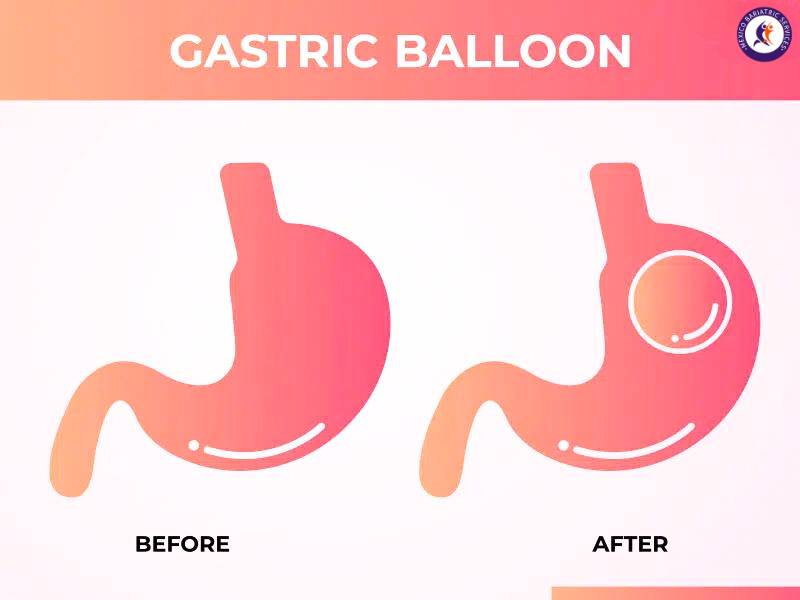 Gastric Balloon in Cancun