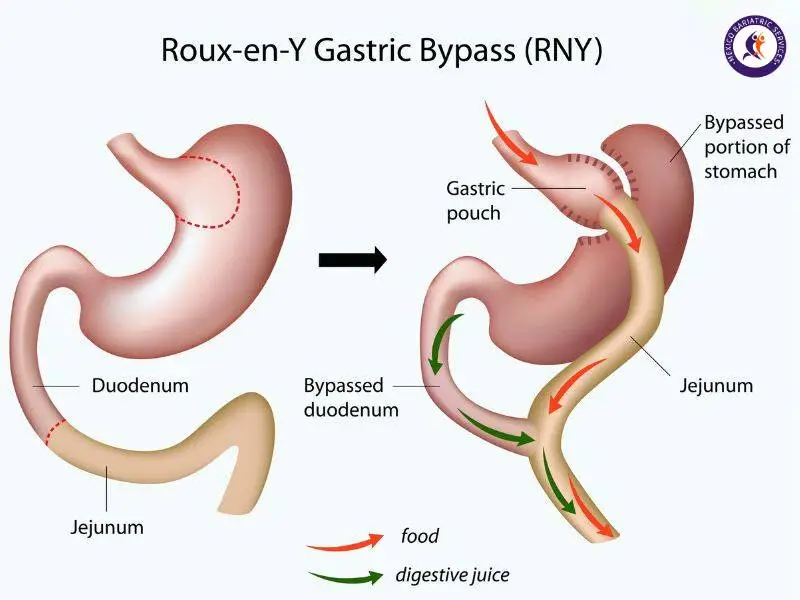 Gastric Bypass