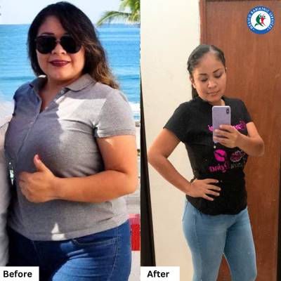 Gastric Sleeve in Guadalajara Before & After