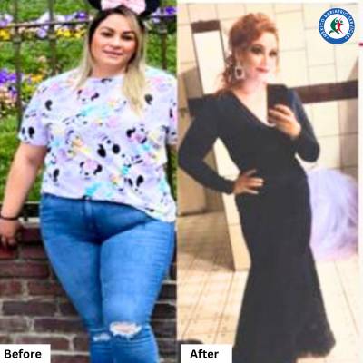 Gastric Sleeve in Guadalajara Before & After