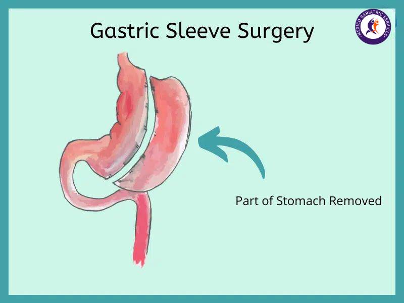 Gastric sleeve in Tijuana, Mexico