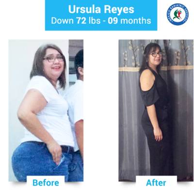 Gastric sleeve Nuevo Laredo Before After, Ursula Reyes shed 72 lbs in 9 months