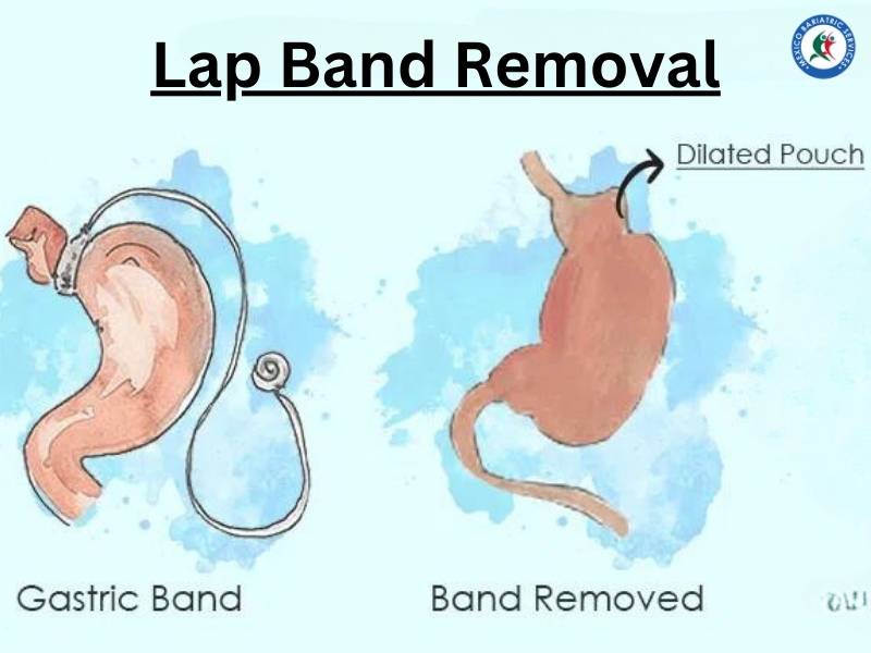 Lap Band Removal