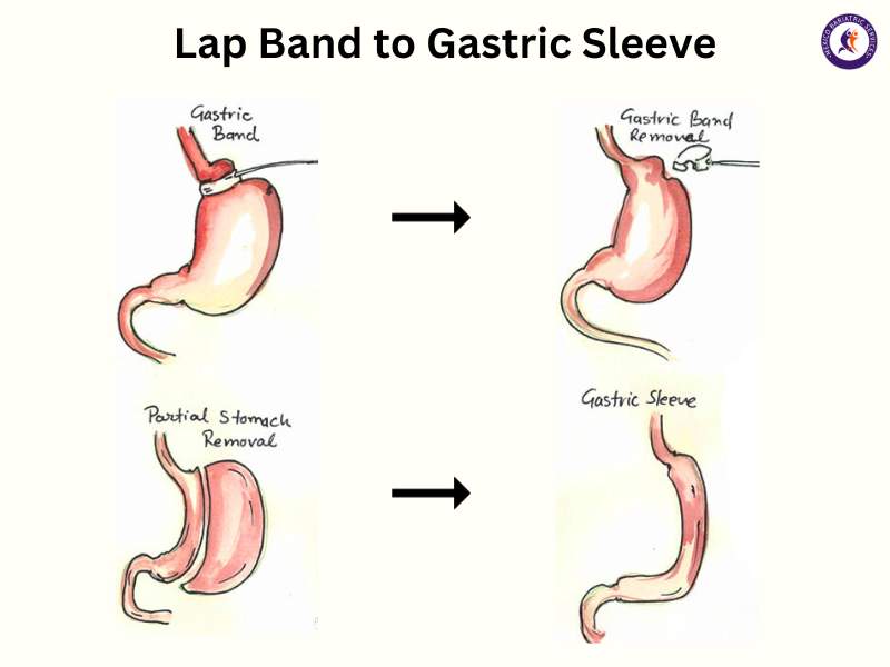 Lap Band to Gastric Sleeve in Cancun